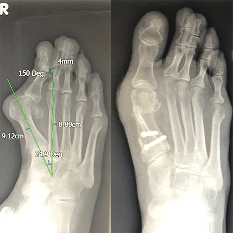 Bunion Surgery | Bunion Removals | Sussex Foot And Ankle Clinic