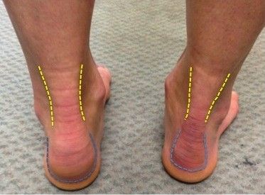 Insertional-Achilles-tendon-clinical-pic