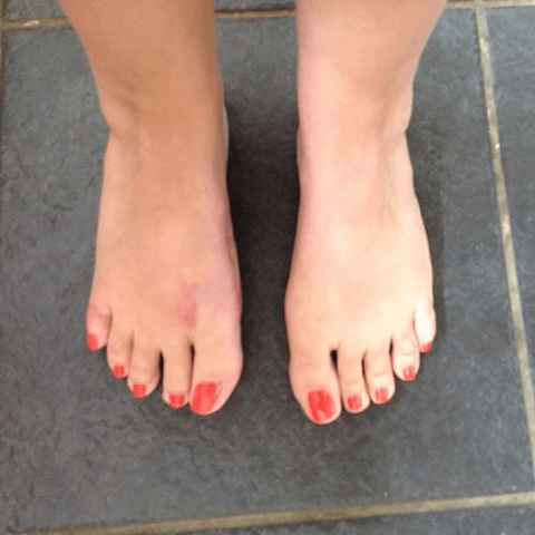 after bunions surgery