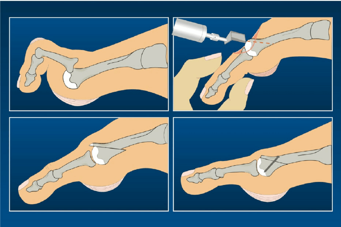 dislocated-MTP-joint