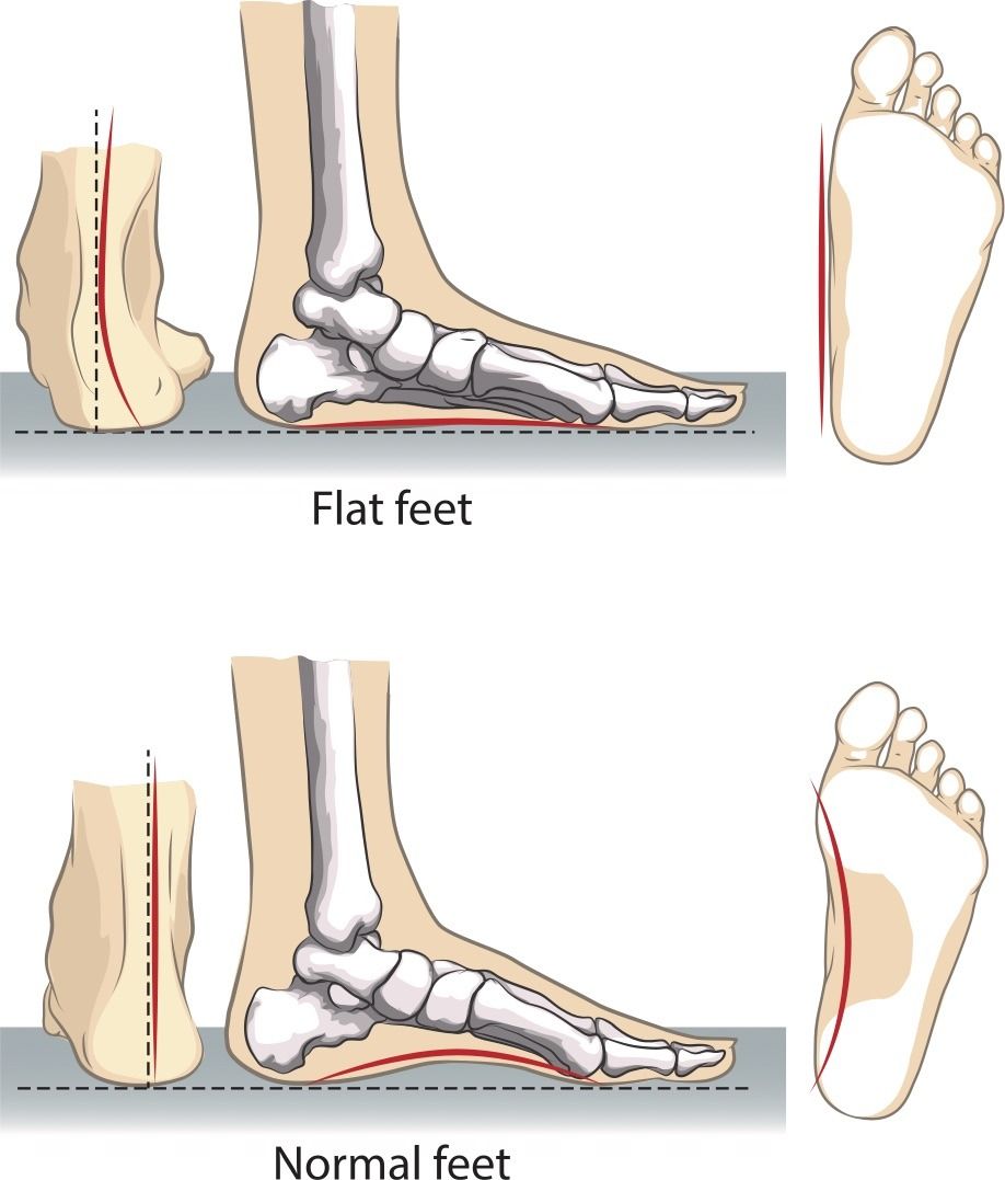 flat-feet