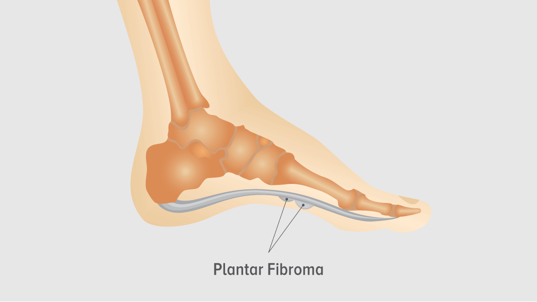 plantar-fibroma-foot