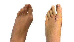 two-weeks-post-bunion-op-left-foot