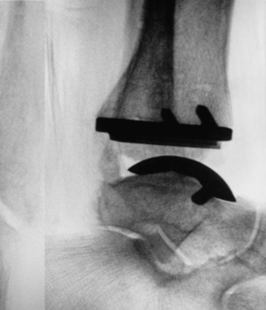ankle-replacement-xray-landscape-1024×716-1